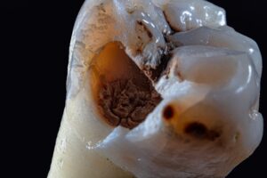 Raty na leczenie implantologiczne - czy to się opłaca?