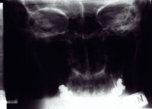 Raty na leczenie laryngologiczne - czy to jest możliwe?